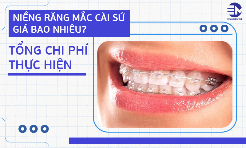 Niềng răng mắc cài sứ giá bao nhiêu? Tổng chi phí thực hiện