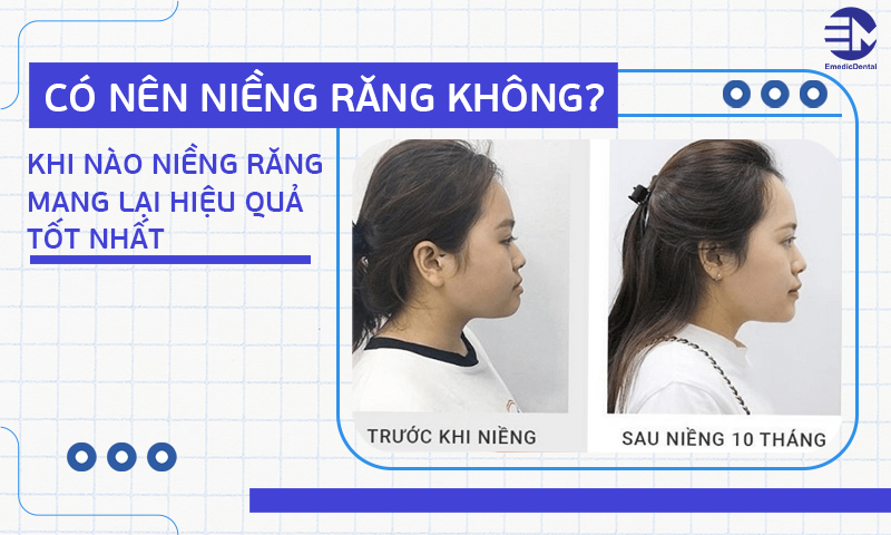 Có nên niềng răng không? Khi nào niềng răng mang lại hiệu quả tốt nhất