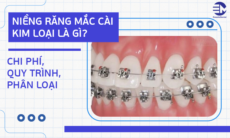 Niềng răng mắc cài kim loại là gì? Chi phí, quy trình, phân loại