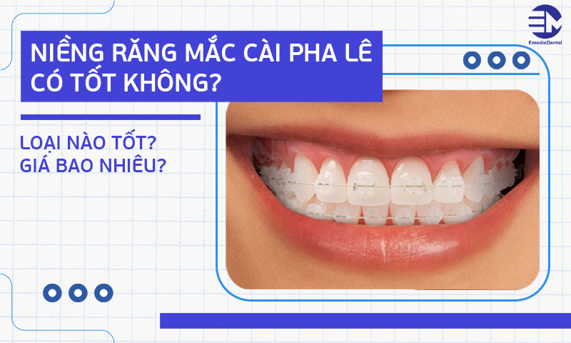 Niềng răng mắc cài pha lê có tốt không? Loại nào tốt? Giá bao nhiêu?