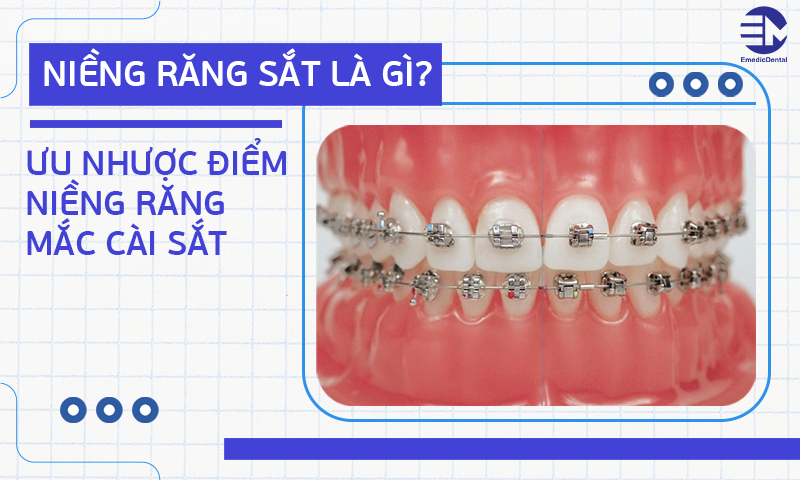 Niềng răng sắt là gì? Ưu nhược điểm niềng răng mắc cài sắt