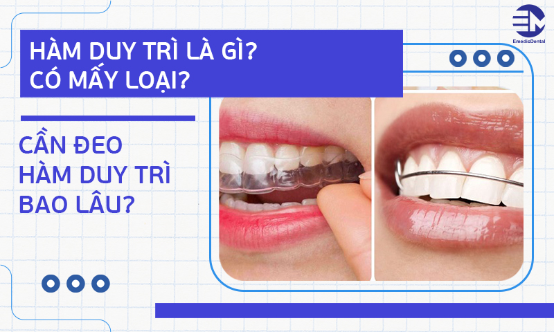 Hàm duy trì là gì? Có mấy loại? Cần đeo hàm duy trì bao lâu?