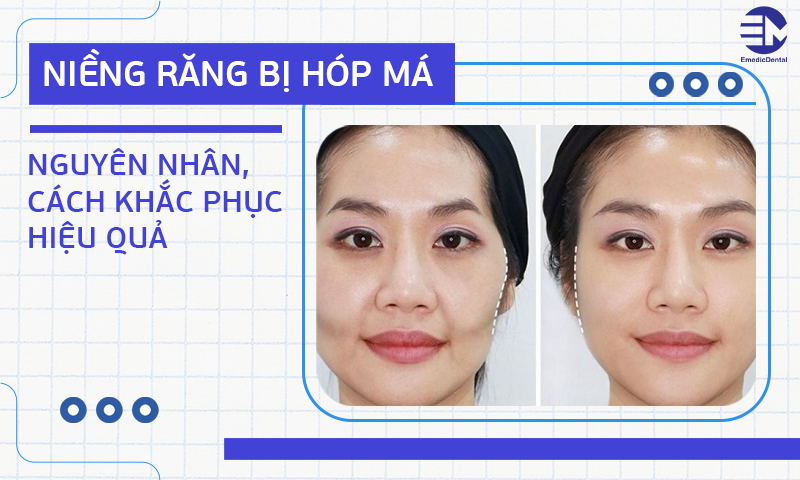 Niềng răng bị hóp má: Nguyên nhân, cách khắc phục hiệu quả