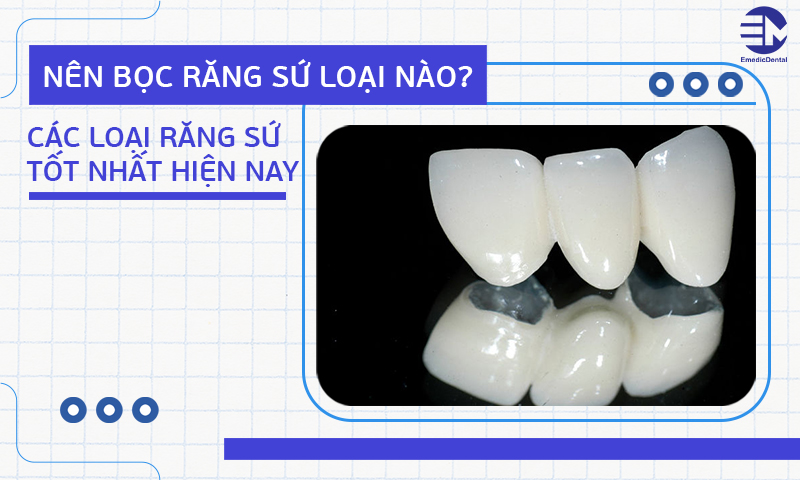 Nên bọc răng sứ loại nào? Các loại răng sứ tốt nhất hiện nay