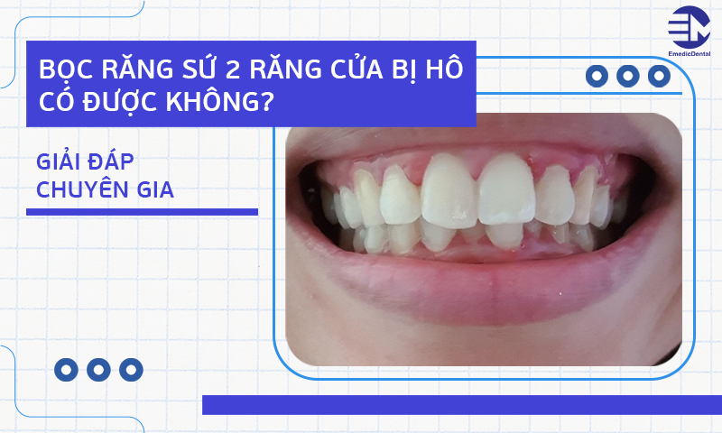 Bọc răng sứ 2 răng cửa bị hô có được không? Giải đáp chuyên gia