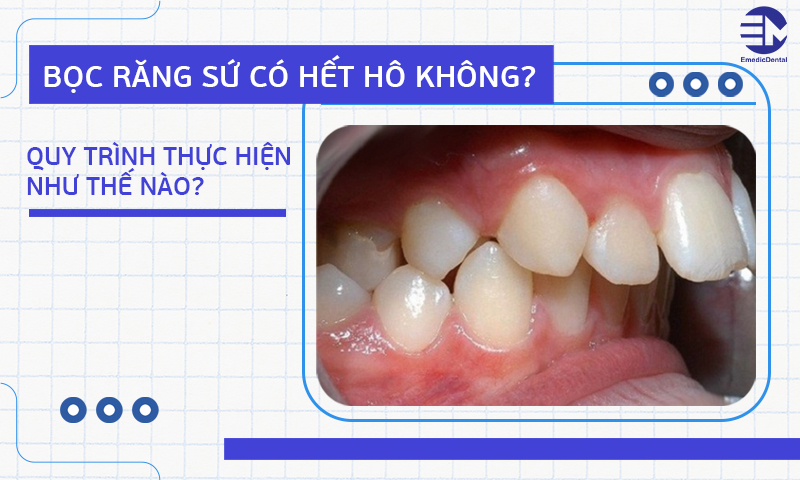 Bọc răng sứ có hết hô không? Quy trình thực hiện như thế nào?