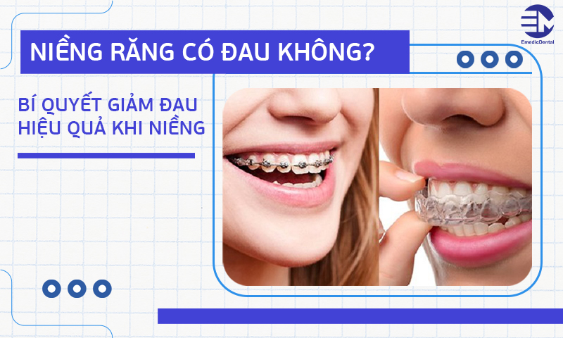 Niềng răng có đau không? Bí quyết giảm đau hiệu quả khi niềng