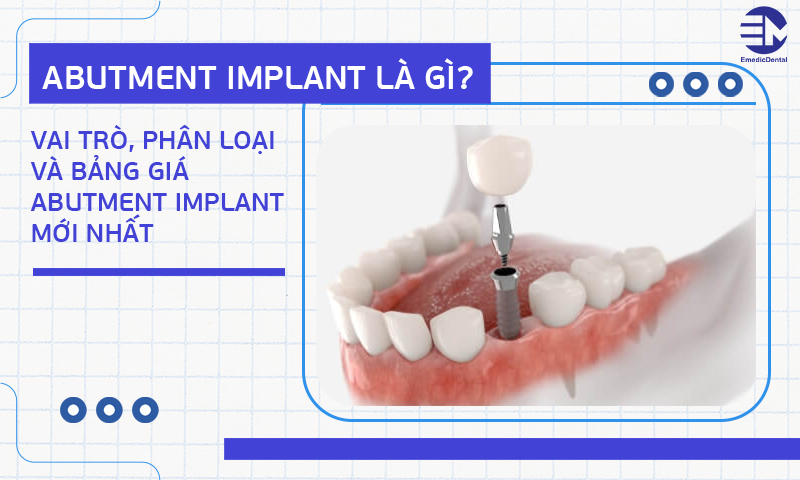 Abutment Implant là gì