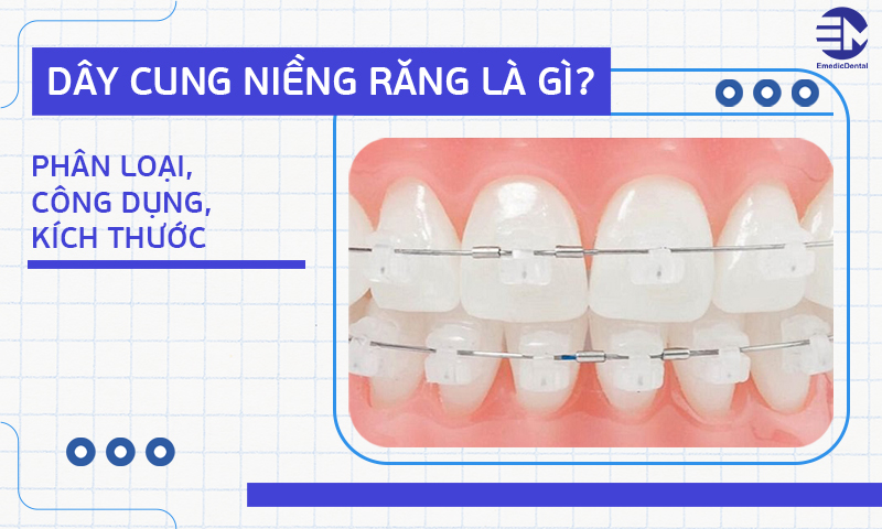 dây cung niềng răng