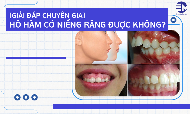 hô hàm có niềng răng được không