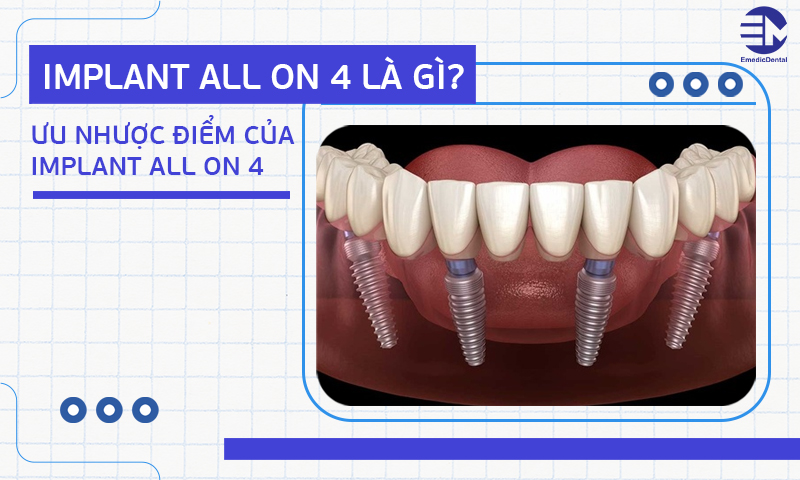 Implant All On 4