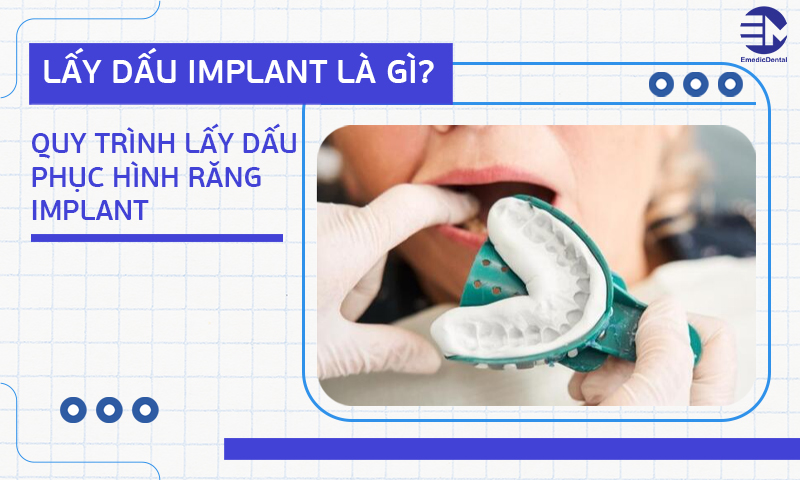 Lấy dấu Implant là gì