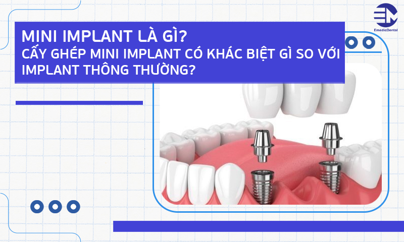 Mini Implant là gì?