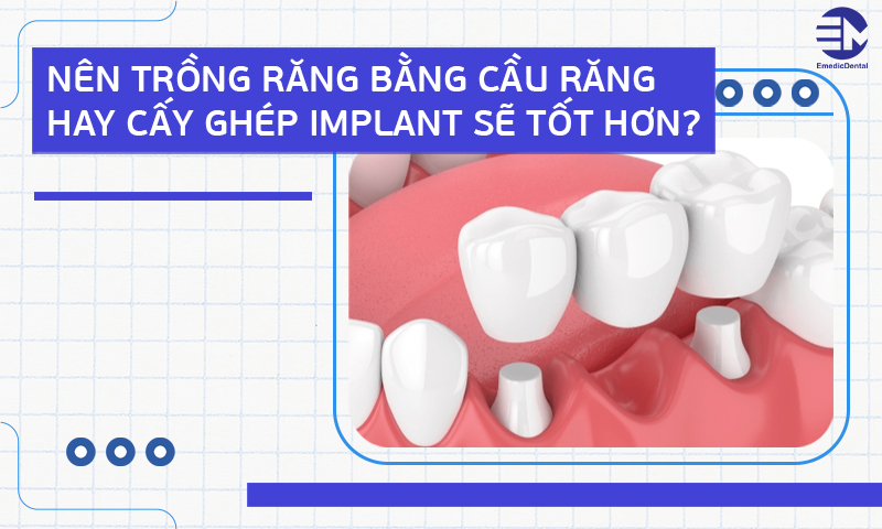 Nên trồng răng bằng cầu răng hay cấy ghép implant sẽ tốt hơn