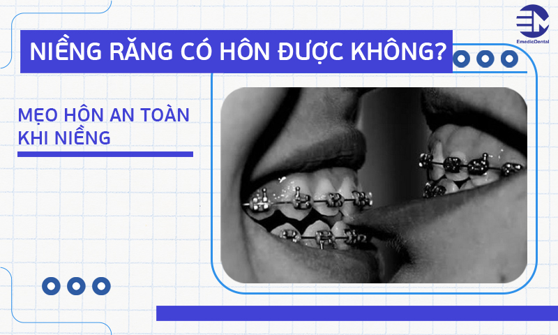 niềng răng có hôn được không