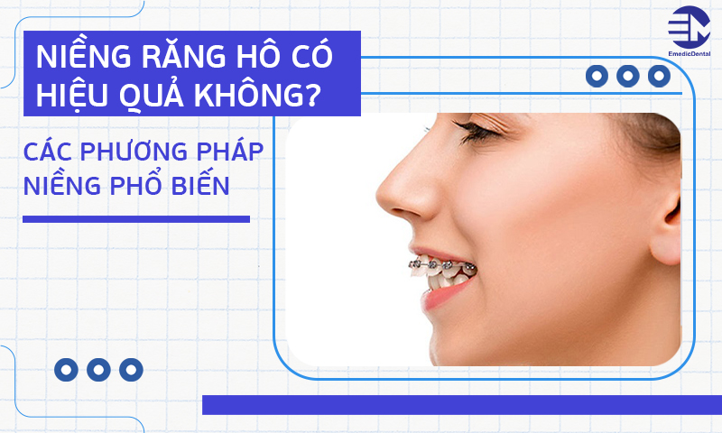 niềng răng hô