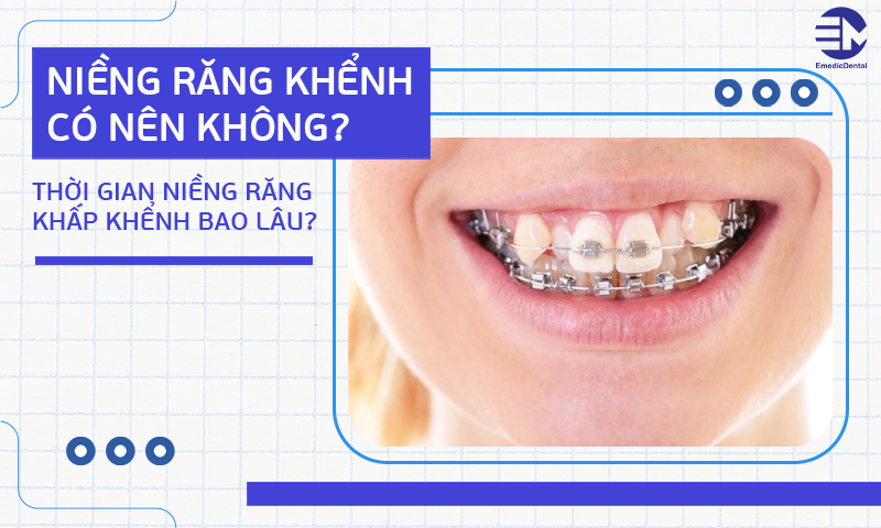 Niềng răng khểnh có nên không