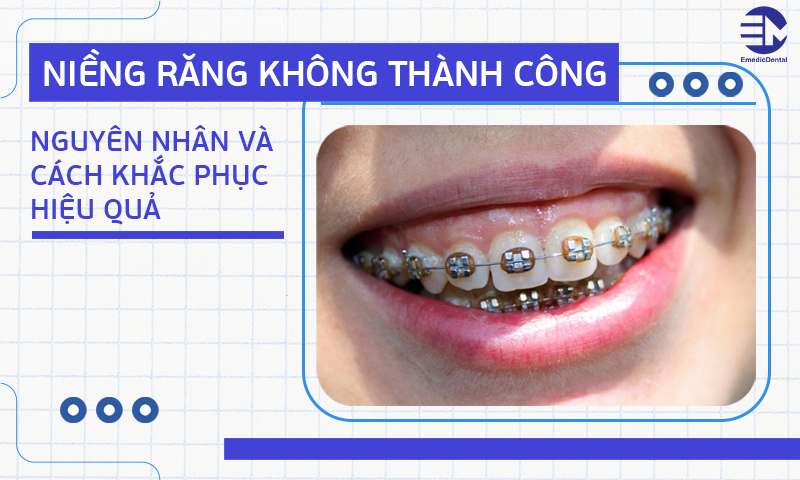 Niềng răng không thành công