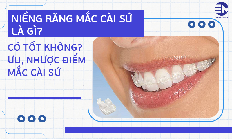 niềng răng mắc cài sứ