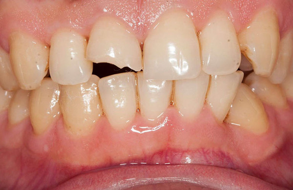  Răng bị bể lớn là như thế nào? Răng bị bể lớn có bọc sứ được không?