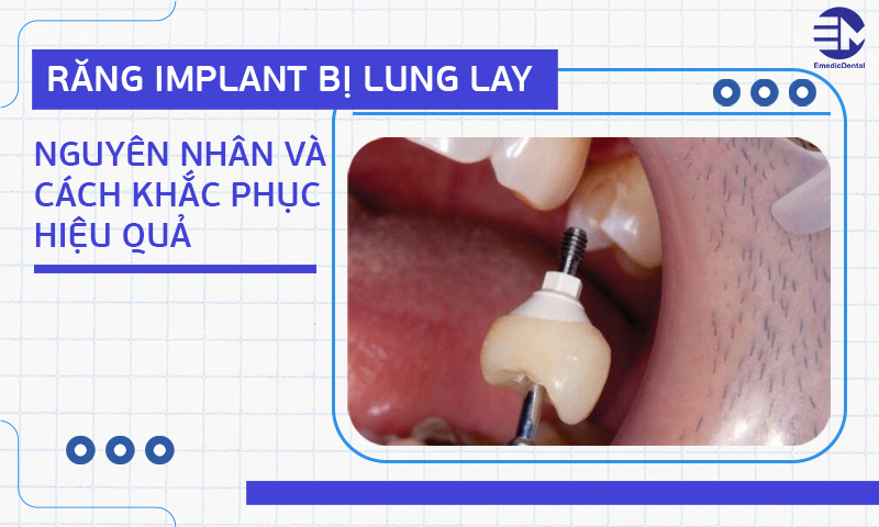 Răng Implant bị lung lay