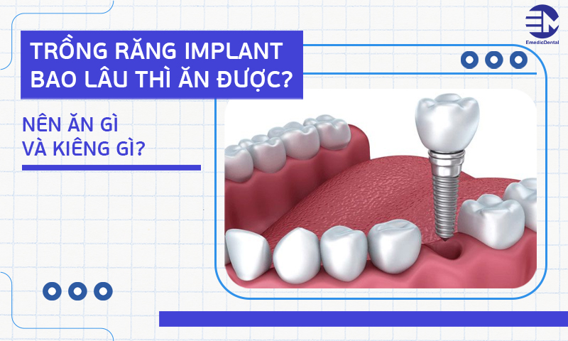 Trồng răng implant bao lâu thì ăn được