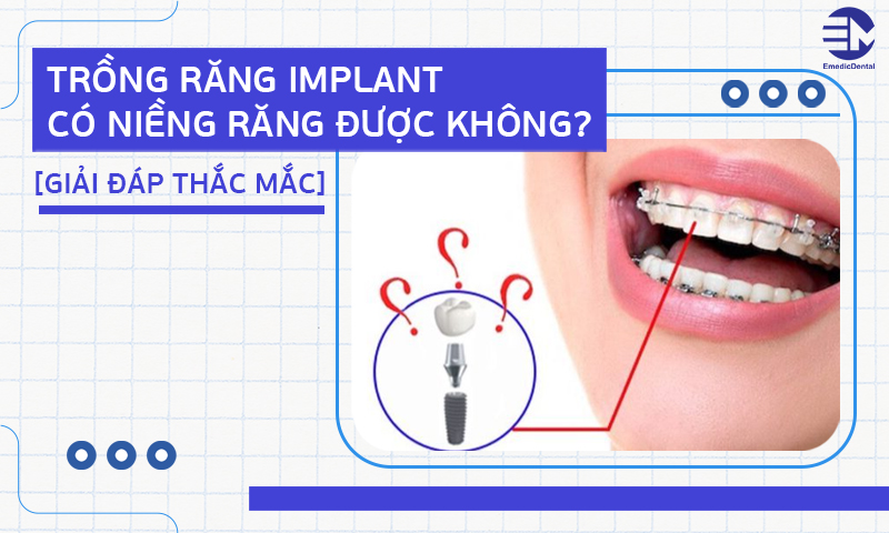 Trồng răng implant có niềng răng được không