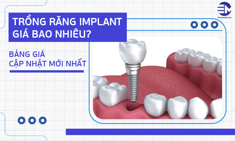 Trồng răng implant giá bao nhiêu