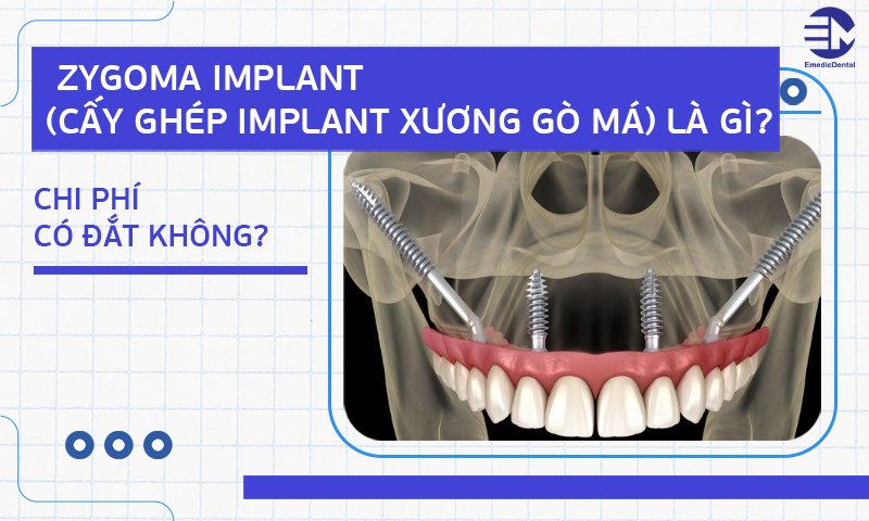 Zygoma Implant (Cấy ghép Implant xương gò má)