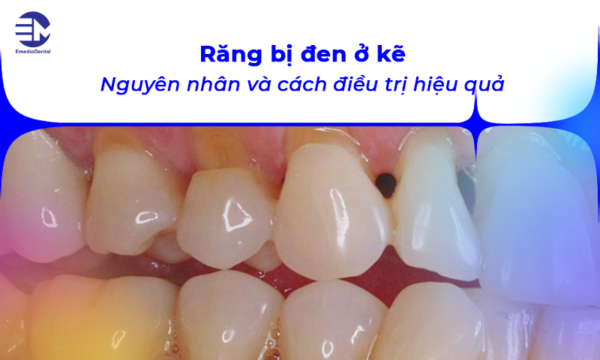 Răng bị đen ở kẽ: Nguyên nhân và cách điều trị hiệu quả