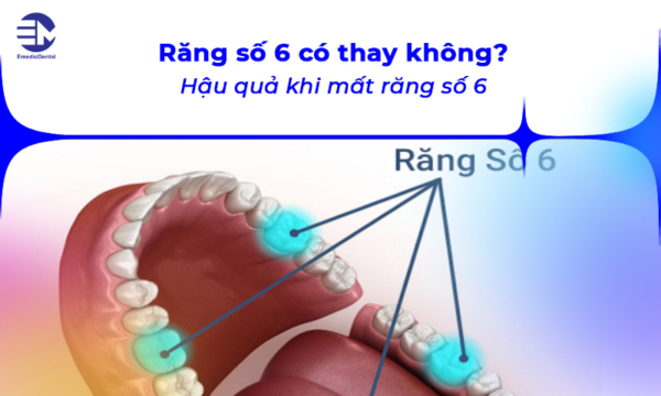 Răng số 6 có thay không? Hậu quả khi mất răng số 6