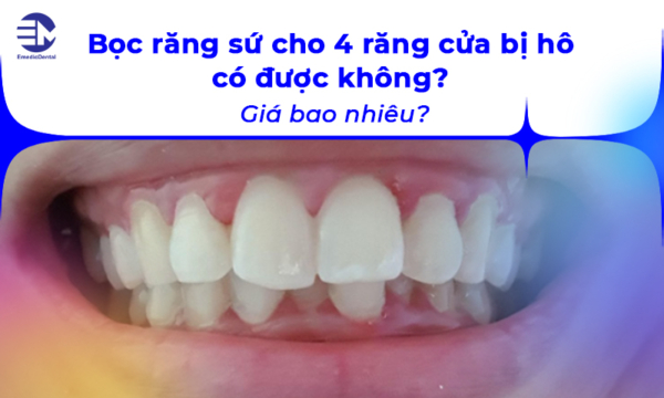 Bọc răng sứ cho 4 răng cửa bị hô có được không? Giá bao nhiêu?