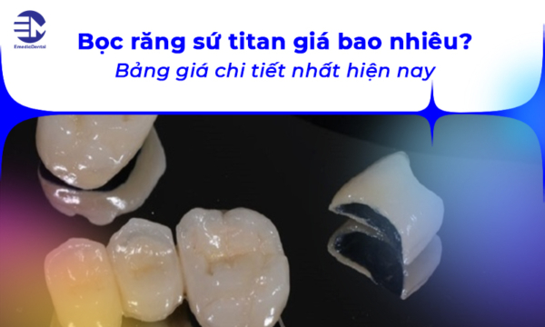 Bọc răng sứ titan giá bao nhiêu? Bảng giá chi tiết nhất hiện nay