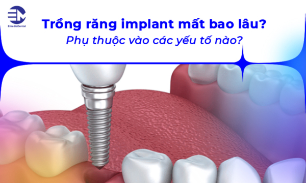 Trồng răng implant mất bao lâu? Phụ thuộc vào các yếu tố nào?