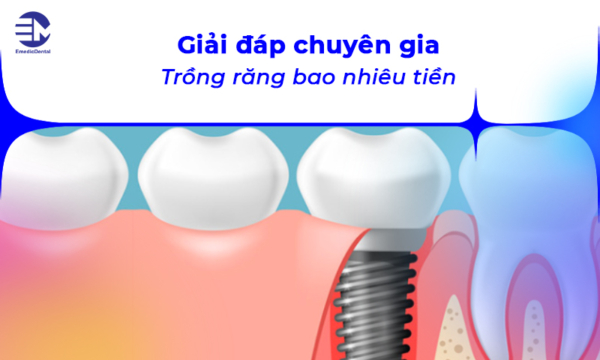 Giải đáp chuyên gia: Trồng răng bao nhiêu tiền?