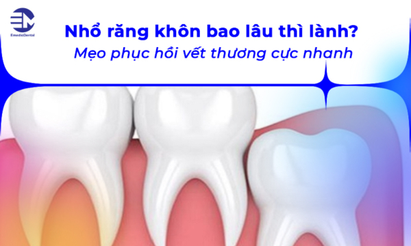 Nhổ răng khôn bao lâu thì lành? Mẹo phục hồi vết thương cực nhanh