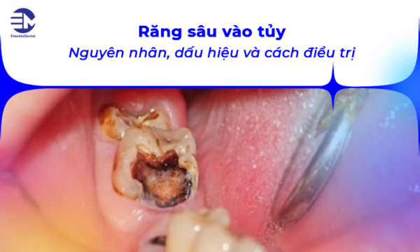 Răng sâu vào tủy: Nguyên nhân, dấu hiệu và cách điều trị