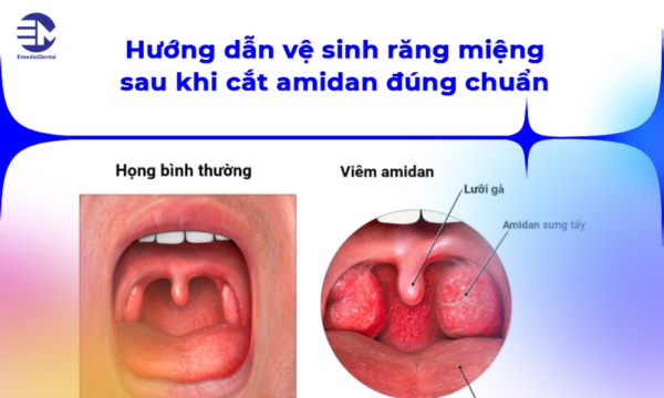 Hướng Dẫn Vệ Sinh Răng Miệng Sau Khi Cắt Amidan Đúng Cách