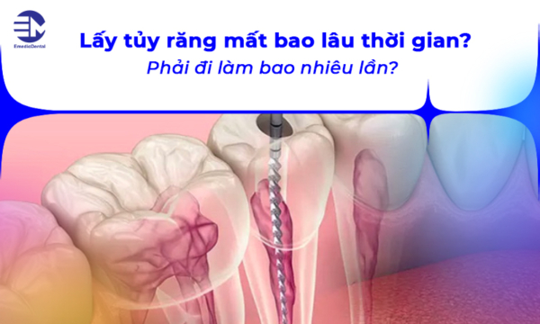 Lấy tủy răng mất bao lâu thời gian? Phải đi làm bao nhiêu lần?