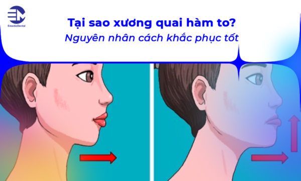 Tại sao xương quai hàm to? Nguyên nhân cách khắc phục tốt nhất