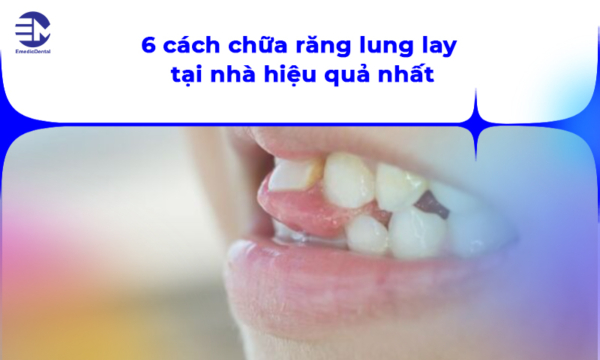 6 cách chữa răng lung lay tại nhà hiệu quả nhất