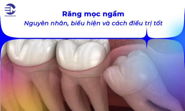 Răng mọc ngầm: Nguyên nhân, biểu hiện và cách điều trị tốt