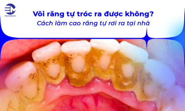 Vôi răng tự tróc ra được không? Cách thực hiện tại nhà