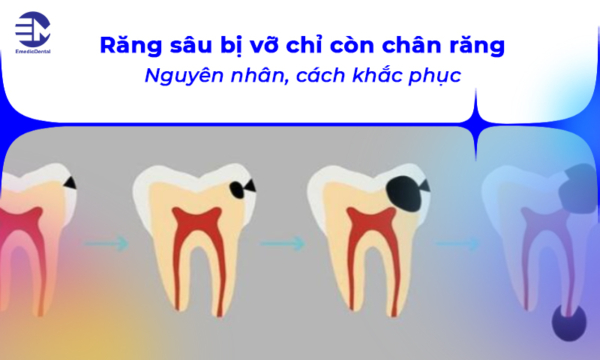 Răng sâu bị vỡ chỉ còn chân răng: Nguyên nhân và khắc phục