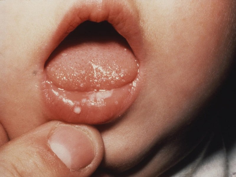 6 mẹo chữa nấm miệng cho trẻ dân gian hiệu quả