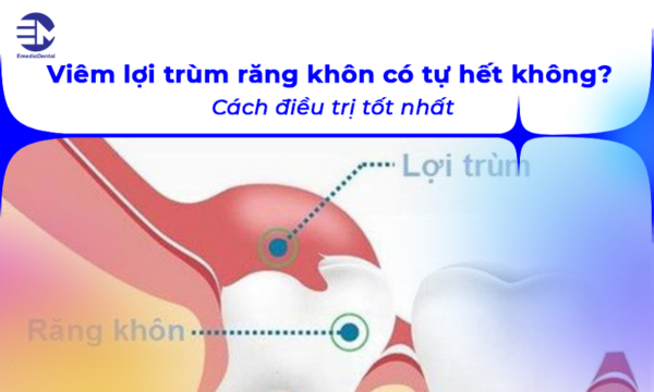 Viêm lợi trùm răng khôn có tự hết không? Cách điều trị tốt nhất