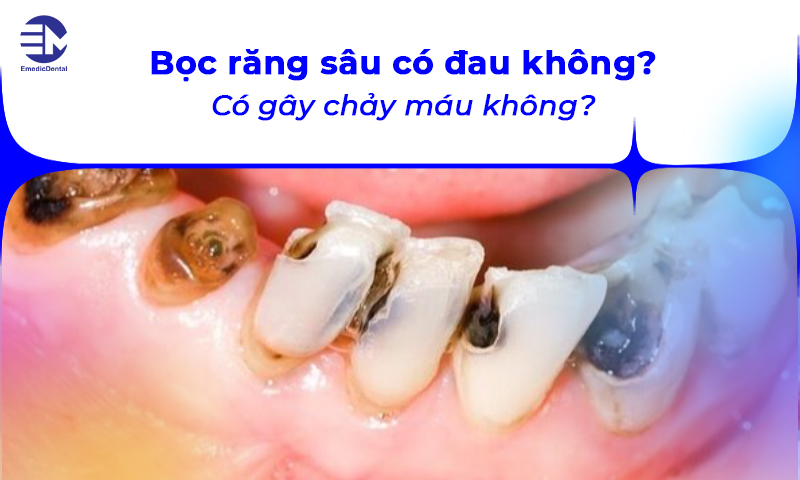 Bọc răng sâu có đau không