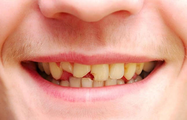Cách phục hồi răng bị mẻ tại nhà đơn giản