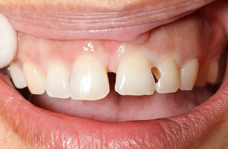 Vì sao nên phục hồi răng mẻ?