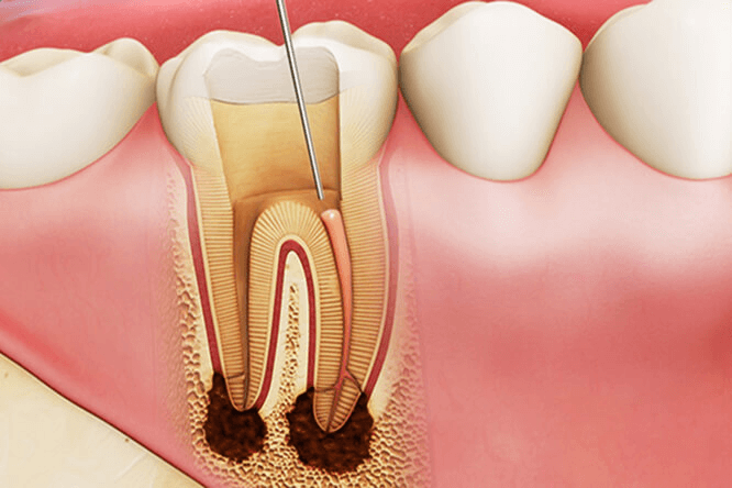 Thông thường phải lấy tủy răng mấy lần thì mới hết bệnh?